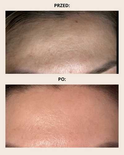 Radiofrekwencja mikroigłowa Poznań